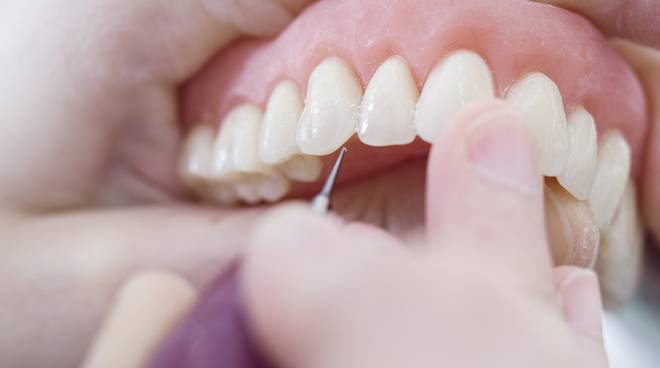 Ti mancano molti denti? scopri quanti impianti dentali si ...