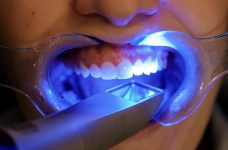 How much does a dental implant cost?