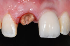Quale può essere la soluzione per i denti incisivi mancanti?