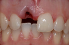 Cerchi una soluzione definitiva per i tuoi denti mancanti?