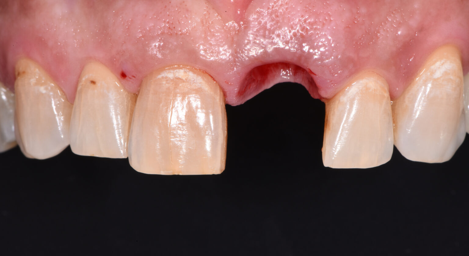Impianto Dentale Dolore Dopo Una Settimana La tecnica dell'implantologia a carico immediato permette di intervenire