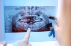 Quali possono essere le cause dei denti che cadono?