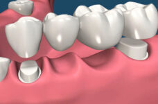 Impianti o ponti dentali? Quali sono le differenze?