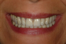 Faccette dentali